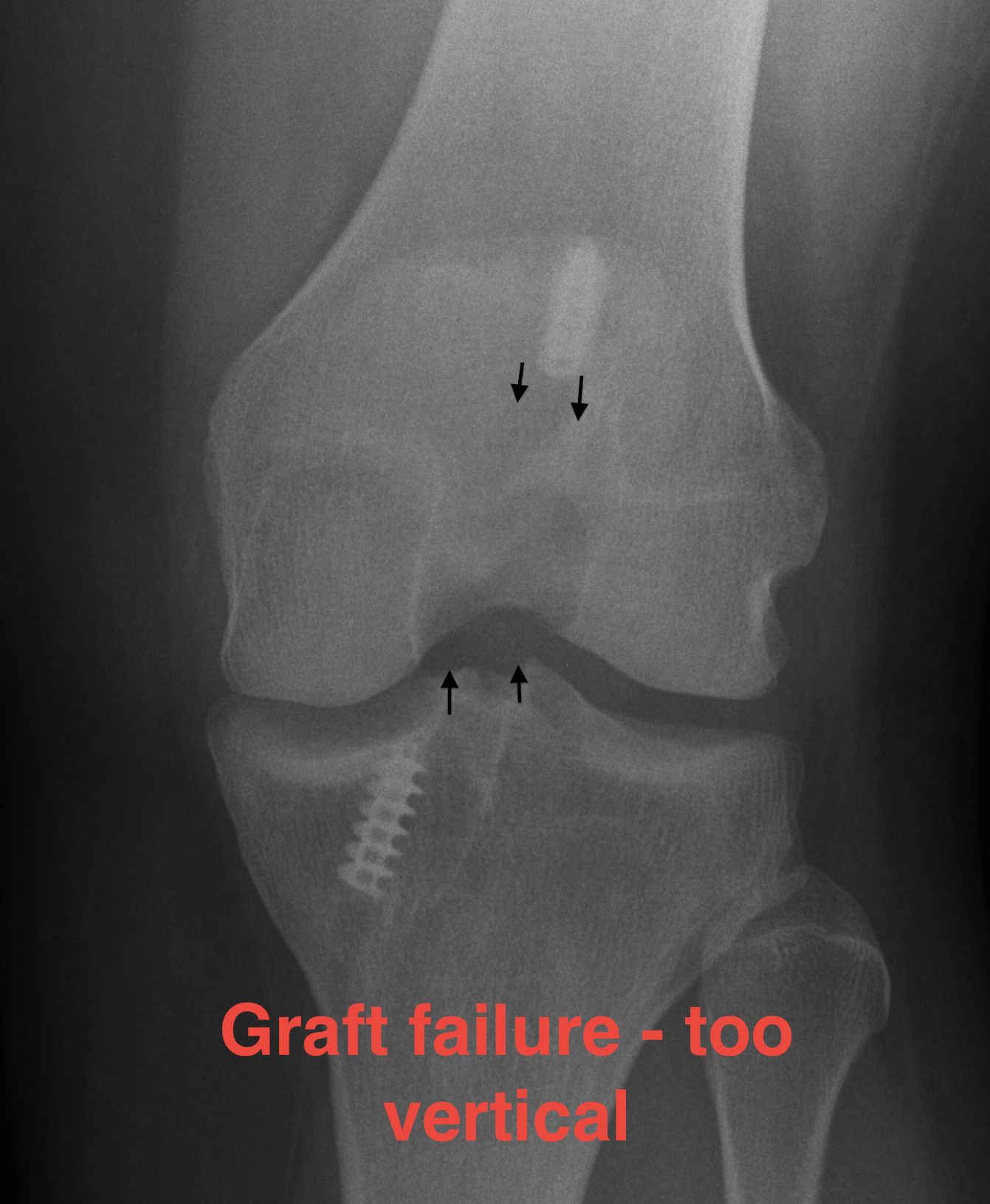 ACL Graft Failure Vertical Tunnels